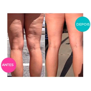 Celulipo funciona para celulites nas pernas antes e depois